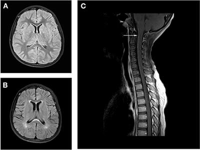 Glial Fibrillary Acidic Protein Astrocytopathy in Pediatric Patients: A Retrospective Study